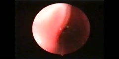 Vocal cords viewed by Endoscopy