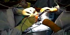 Transmetatarsal Amputation for Gangrene