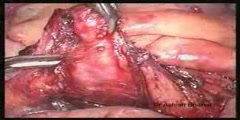 Laparoscopic Appendectomy Steps