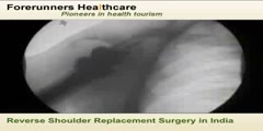 Reverse Shoulder Replacement Surgery in India