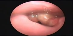 Epiglottitis Treament