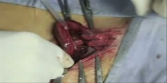 Hernia repair using ultrapro mesh and fibrin glue