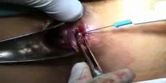 Lateral internal sphincterotomy treatment