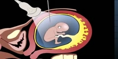 Amniocentesis Ultrasound How it it Performed Guided