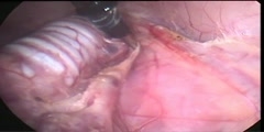 Transoral Access for Endoscopic Thyroid Resection
