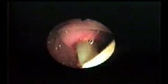 Extraction of worm from bile ducts