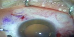 Pterygium Surgery with Conjunctival Autograft