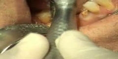 Fractured Teeth Implant And Extraction