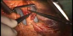 Heart Surgery Video