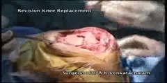 Revision Knee Replacement - Part 2