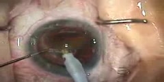 Modern Cataract Surgery Video