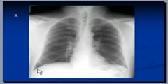 Pneumonia radiologic anatomy