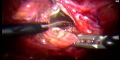 Lower Urinary Tract Laproscopy