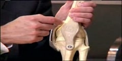 Minimally Invasive Knee Replacement