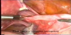 Tubal ectopic pregnancy treated by salpingectomy