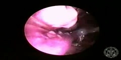 Endoscopic Vein Harvest