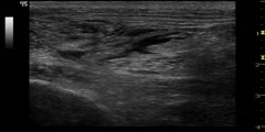 UltraSound Guided Sciatic Nerve Block