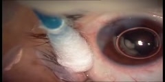 Intravitreal TSA injection Treatment