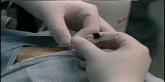 Radial Artery Catheterization Procedure and Techniques