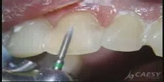 Bonding of Teeth