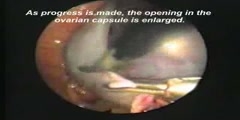 Ovarian Cystectomy Procedure
