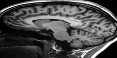 MRI Scan of the Human Brain