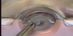 Removal Of Intra-Uterine Device IUD