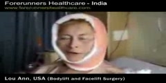 Face lift Surgery in India