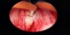 Bladder neck incision video