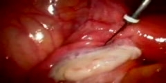 Live laparoscopic tubal ligation surgery