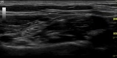 Interscalene Nerve Block