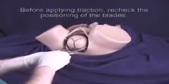 Obstetrical Forceps  - Scientific Video and Animation Site