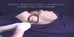 Obstetrical Forceps - Scientific Video and Animation Site Obstetrical Forceps - Scientific Video and Animation Site