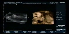 4D Ultrasound Scan