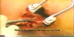 Surgical Fistulectomy