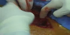 Performing  Laparotomy