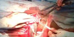 histerectomia abdominal procedure