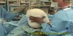 Immediate Postsurgical Above Knee Amputation