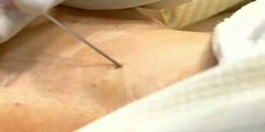 Administering Internal jugular vein puncture