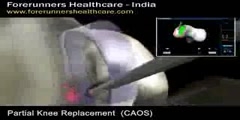 Partial Knee Replacement Surgery in India