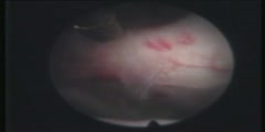 Video on Endoscopic Brain Surgery
