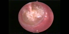 Middle ear infection