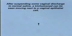 Vaginal Discharge Wet Mount