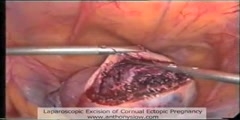 How a Laparoscopic excision is done in a Ectopic Pregnancy