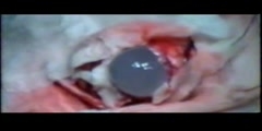 How is the hydrated cysts in brain removed?
