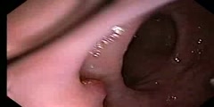 Colonoscopy with diverticulosis and a polyp Video