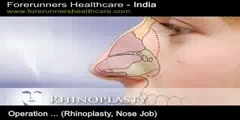 Nose Job Surgery