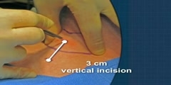 Cricothyrotomy