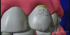 Implant of Teeth