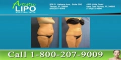 Tampa body contouring